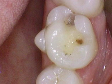 충정로 치과 인레이 해야한다고 들었는데 충치가 안보여요 관련 이미지 8