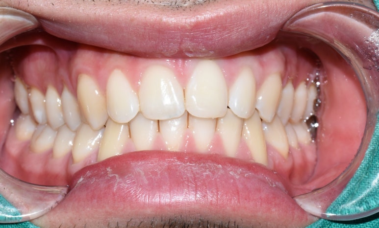 [을지로/명동 근처 치과] 앞니 레진 치료사례 관련 이미지 10