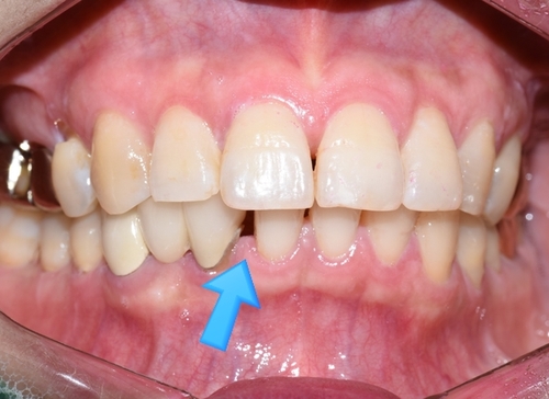 벌어진 앞니 교정치료 & 오래된 앞니 브릿지 다시하기 관련 이미지 1