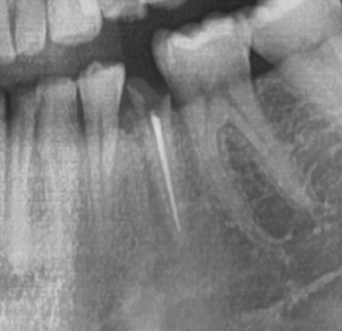 신경치료 끝났는데 크라운 해야하나요? 자연스러운 지르코니아 크라운 유명한 치과 가격까지 관련 이미지 3