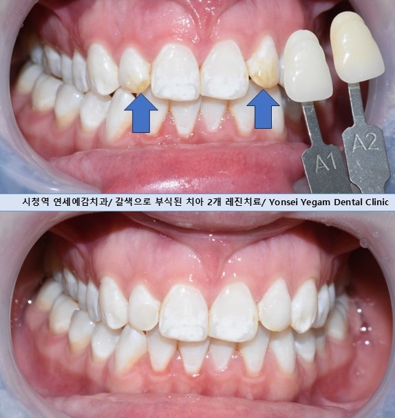 충정로치과,을지로치과/ 치아뿌리쪽이 패이고 부식된 것처럼 누렇게 보인 치경부 마모 레진 치료 증례 관련 이미지 9