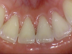 [시청역치과]해외에서도 일부러 치료받으러 오는 치과가 있다구요? 스케일링도 연세예감치과! 관련 이미지 4