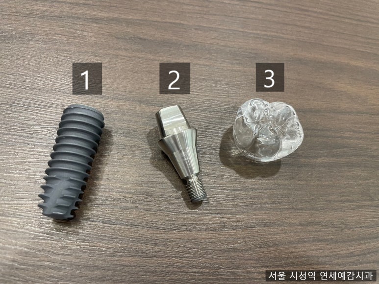 [서울시청역치과] 다른 치과에서 오래전에 한 임플란트가 흔들려요 &rarr;재수술 케이스 관련 이미지 4