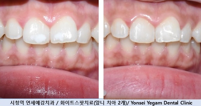 앞니전문으로 외국인들이 찾아오는 연세예감치과에서 알려 드리는 하나만 변색된 앞니의 크라운치료 관련 이미지 8
