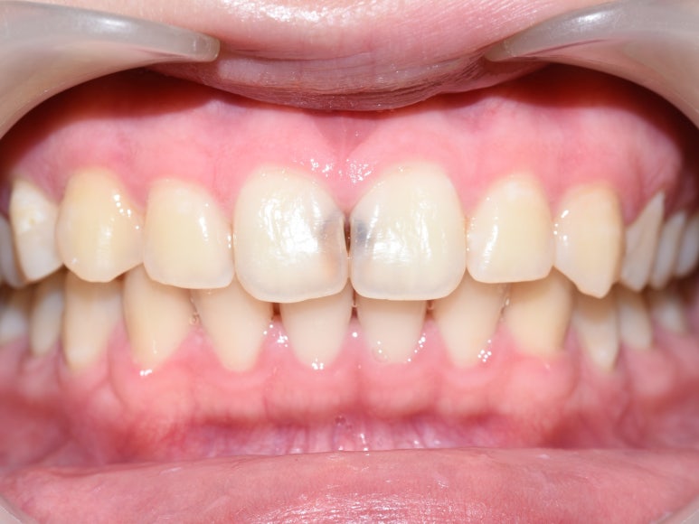 앞니충치가 너무 심해요 앞니 충치치료 방법 [시청역서울역 치과] 관련 이미지 3