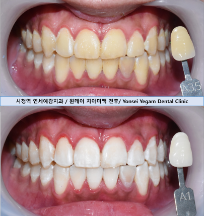 치아미백 치과추천 외국인관광객들도 필수코스로 찾아와서 치아 미백하는 치과 관련 이미지 4