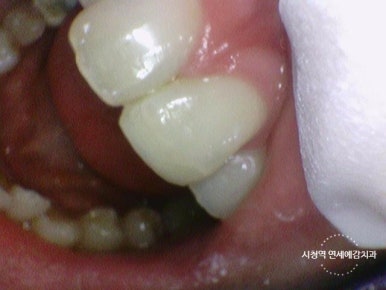 깨진 치아 레진치료 방법 실제사진 관련 이미지 5