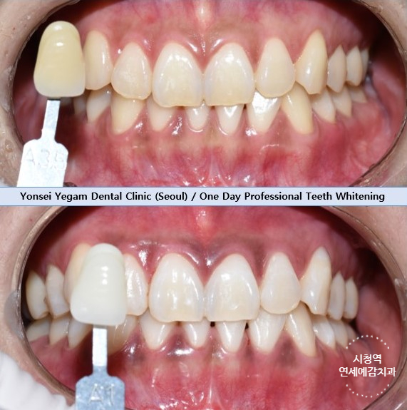 서울역 치아미백 직접 미백제 공장 갔다온 미백에 진심인 원장님의 치과 [feat.외국인미백관광으로도 유명] 관련 이미지 1