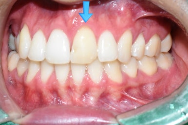 [광화문/치과] 외국인환자 변색된 앞니 하나의 크라운 치료 실제 케이스 관련 이미지 7