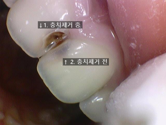 앞니충치가 너무 심해요 앞니 충치치료 방법 [시청역서울역 치과] 관련 이미지 7