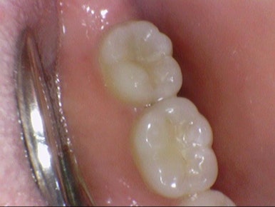 [을지로가까운치과]아말감충치 치료사례 아말감 주변 2차충치를 레진/인레이/크라운으로 치료 관련 이미지 3