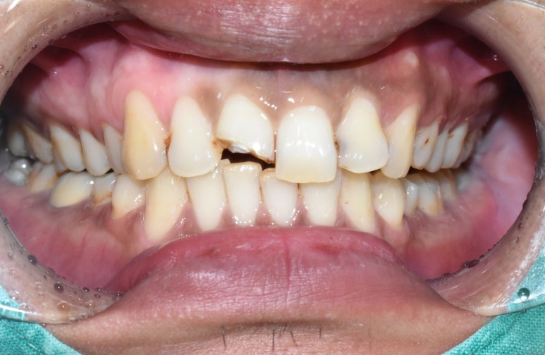 앞니 하나가 부러졌어요 앞니 크라운 앞니 브릿지 관련 이미지 7