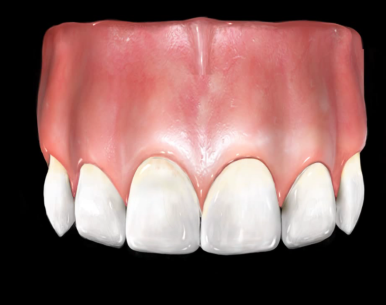 서울시청역 남대문 임플란트 대신에 앞니 브릿지를 한 케이스 관련 이미지 3