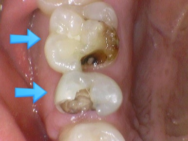 신경치료 끝났는데 크라운 해야하나요? 자연스러운 지르코니아 크라운 유명한 치과 가격까지 관련 이미지 5