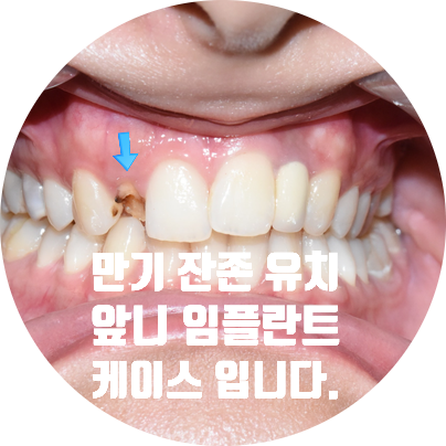 네비게이션임플란트 이용한 앞니 치료 유명한 치과 잔존 유치 케이스 관련 이미지 2