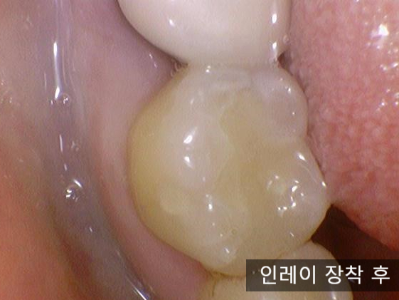 [충정로/치과] 인레이해야한다고 진단받으셨나요? 이맥스(세라믹)인레이 실제케이스 같이 살펴보아요 관련 이미지 11
