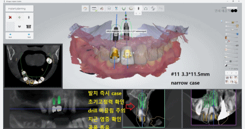 [남대문] 치과임플란트 조금더 덜아프고, 간단하게! 관련 이미지 2