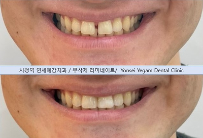 [광화문]라미네이트/무삭제 프리네이트 케이스(벌어진치아,충치,옥니,치아모양개선,왜소치)/이벤트비용안내 관련 이미지 3