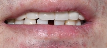 시청역치과 벌어진 앞니를 바르고 이쁘게! 대한심미학회회원치과 관련 이미지 13