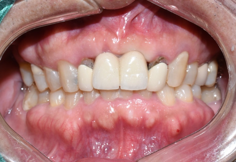 [서울시청역/서울역] 앞니 임플란트 가능할까요? 앞니 내비게이션임플란트 관련 이미지 10