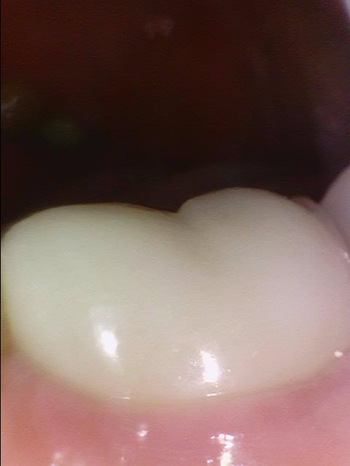 해외에서도 믿고 찾아오는 서울 시청역 치과 연세예감치과에서 소개하는 지르코니아 크라운 관련 이미지 14