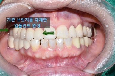 충정로 서울역 근처 고난도 & 재수술 임플란트 수술 치과 관련 이미지 15