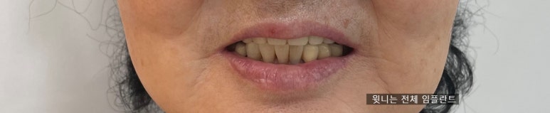 앞니 여러개 임플란트 잘하는 치과 서울역치과 실제사진 관련 이미지 25
