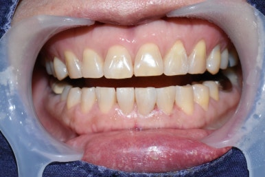 앞니사이벌어짐, 레진으로 메울 수 있을까? 비용,가격까지. 종로치과/광화문 치과 관련 이미지 2