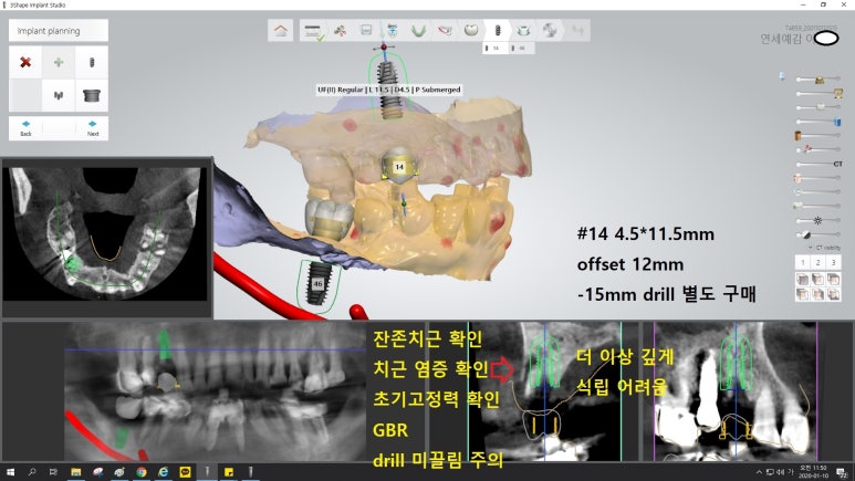 [북창동 치과/연세예감치과]내비게이션임플란트소개 관련 이미지 20