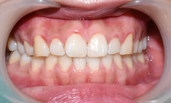 [서울역/시청역] 레진치료 : 화이트스팟(반상치) 케이스 & 치아패임으로 시린 케이스 & 깨진 치아 케이스 관련 이미지 9