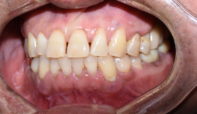 [서울시청역/남대문]어금니임플란트+상악동거상술(뼈이식):실제케이스 관련 이미지 11