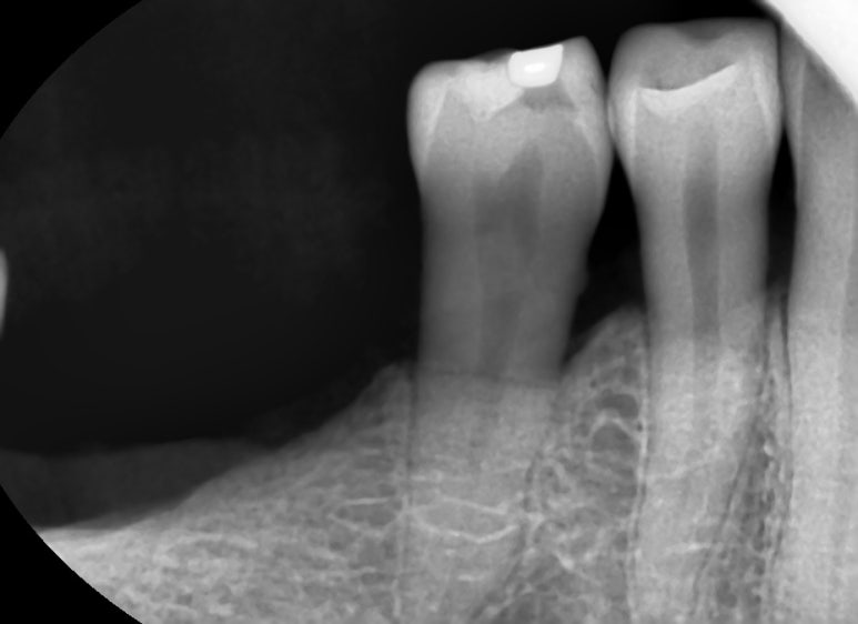 [서울역/치과] 고기 뼈를 씹고 치아가 부러졌어요 관련 이미지 2