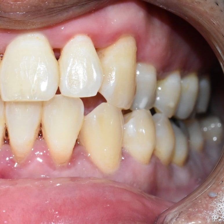 서울시청역 외국인환자 잇몸치료 전후 일주일만에 변화된 사진 관련 이미지 4