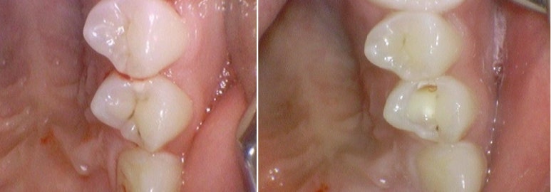 순화동 가까운 충치치료 치과 해외에서도 찾아오는 연세 예감 치과 관련 이미지 6