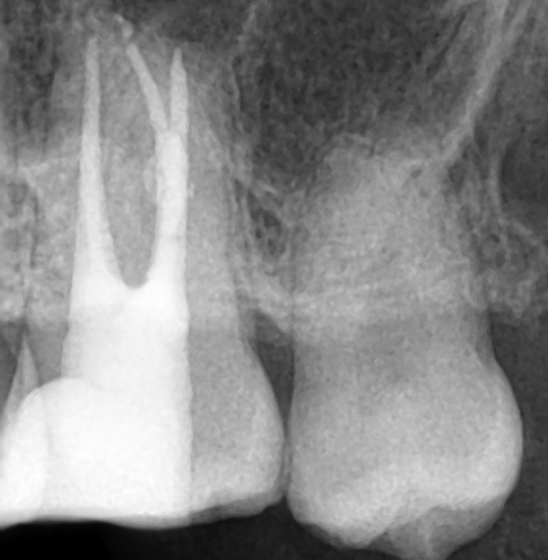 시청역치과 충치치료, 많이 썩었을 때? 신경치료에 대해 알아보아요 관련 이미지 4