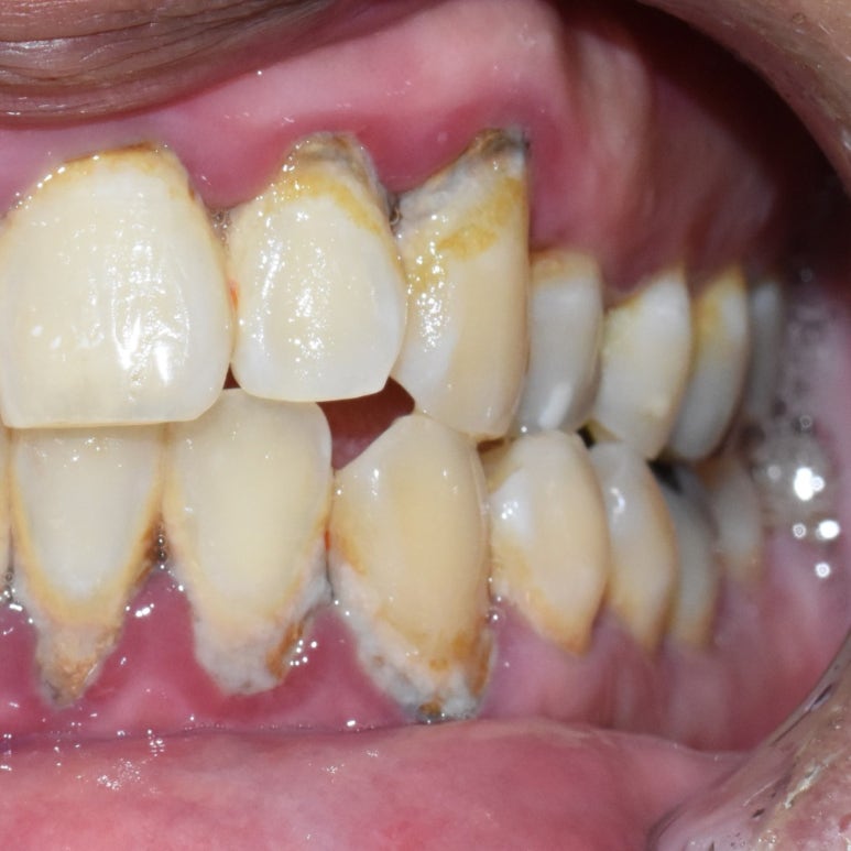 서울시청역 외국인환자 잇몸치료 전후 일주일만에 변화된 사진 관련 이미지 3