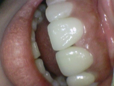 앞니 치아가 부러졌다면? 앞니부러짐 시청역 서울역 치과 치료사례 관련 이미지 10