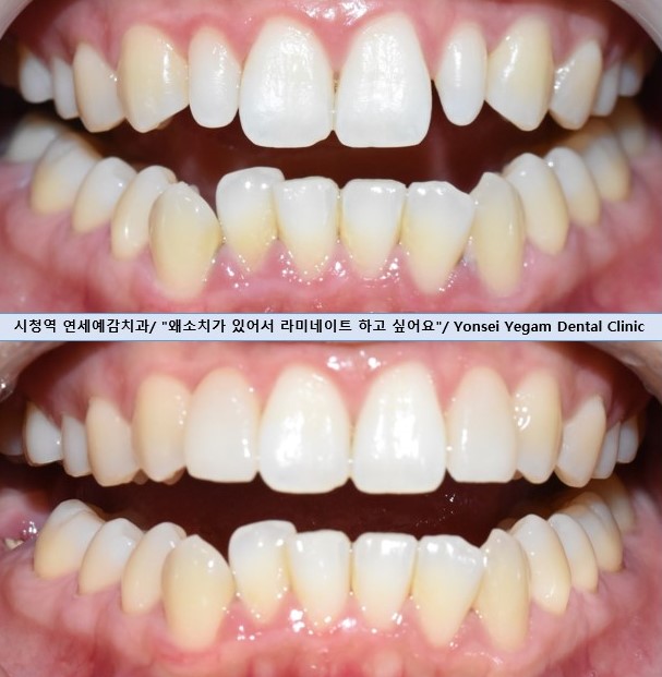 앞니가 작아 고민이신가요? 왜소치 무삭제 라미네이트로 자연스럽게 해결! 해외에서도 찾아오는 치과 비용까지 관련 이미지 4