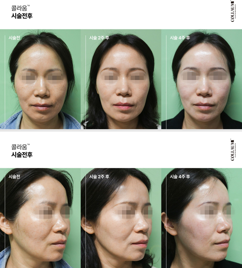True Recovery from Within the Skin Through Colaum Collagen Booster image 5
