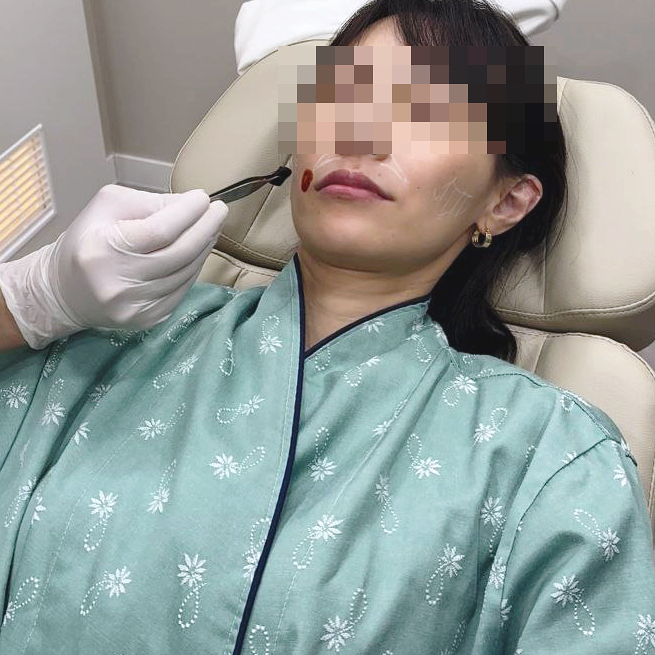 Types of Hollow Cheek Treatments and Restoring Volume with Radiesse image 12