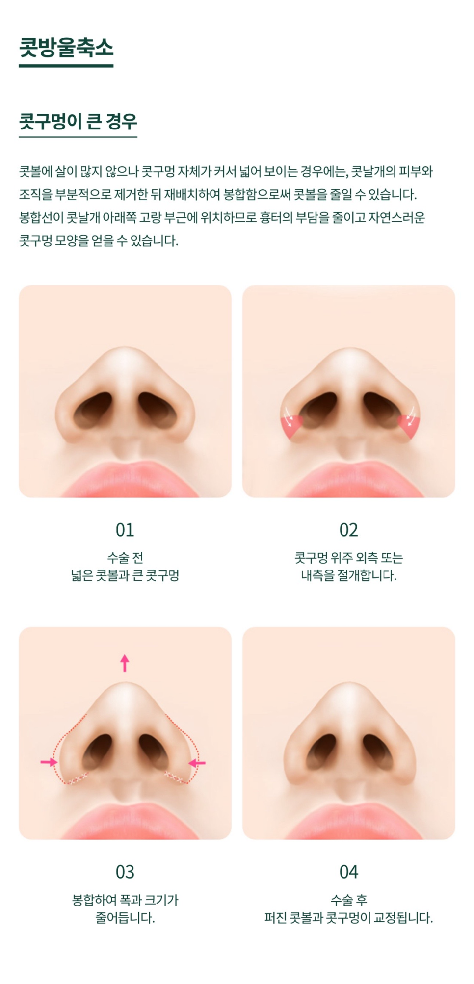 Creating a Harmonious Impression with Nostril Reduction and Nose Thread Lifting/Filler image 4