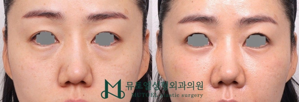 Under-Eye Fat Repositioning and Lower Blepharoplasty: A Choice That Improves Your Impression image 5