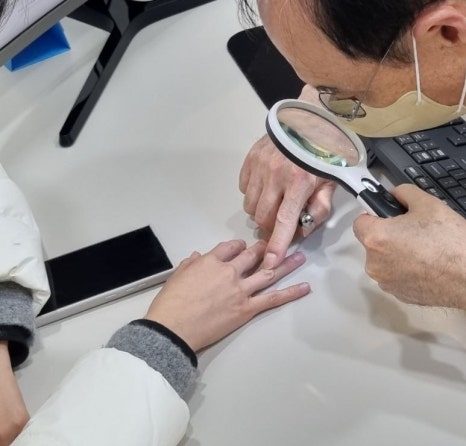 Cryotherapy Review for Finger Warts and a Video of the Actual Treatment Process Included image 6