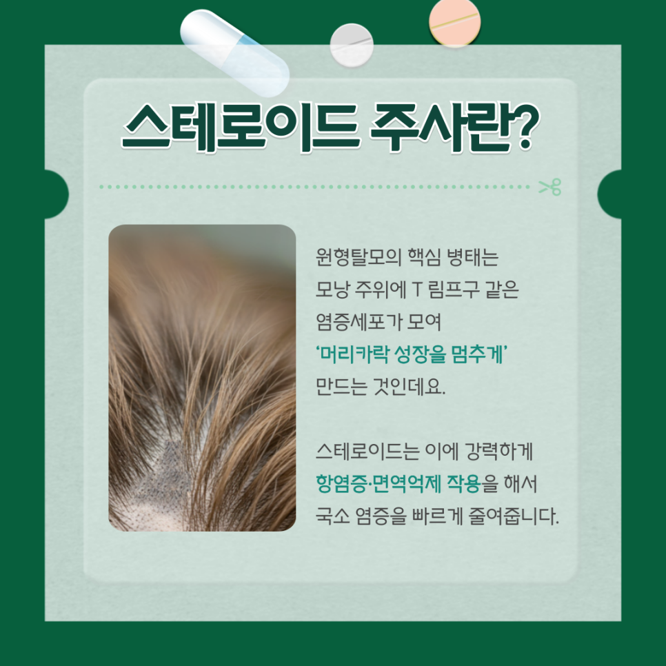 원형 탈모, 국소 스테로이드 주사로 근본적 해결을 관련 이미지 1