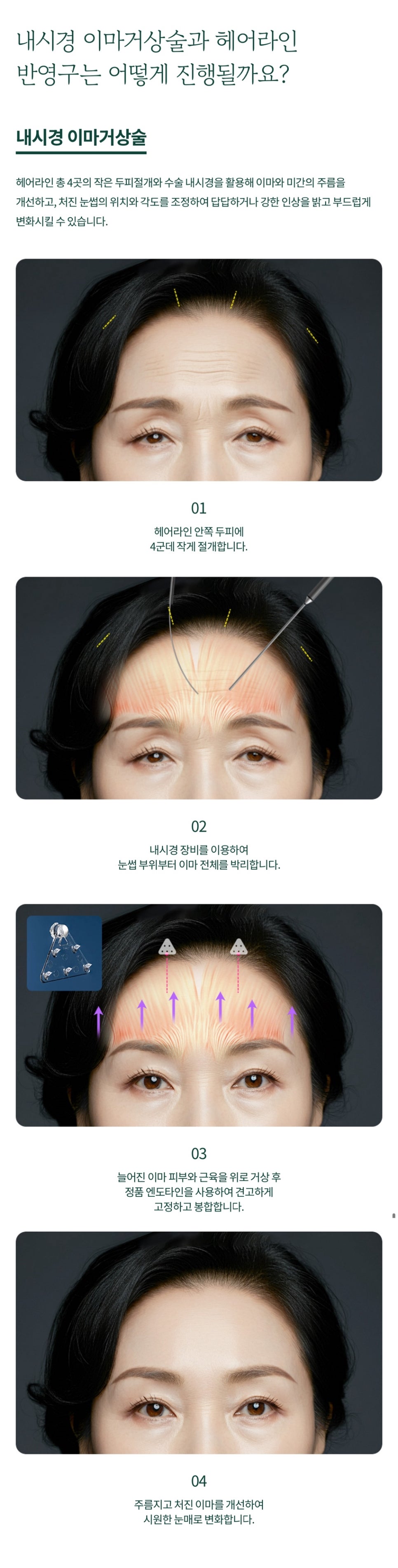 내시경 이마거상 답답한 중년 인상 개선을 원한다면 관련 이미지 4