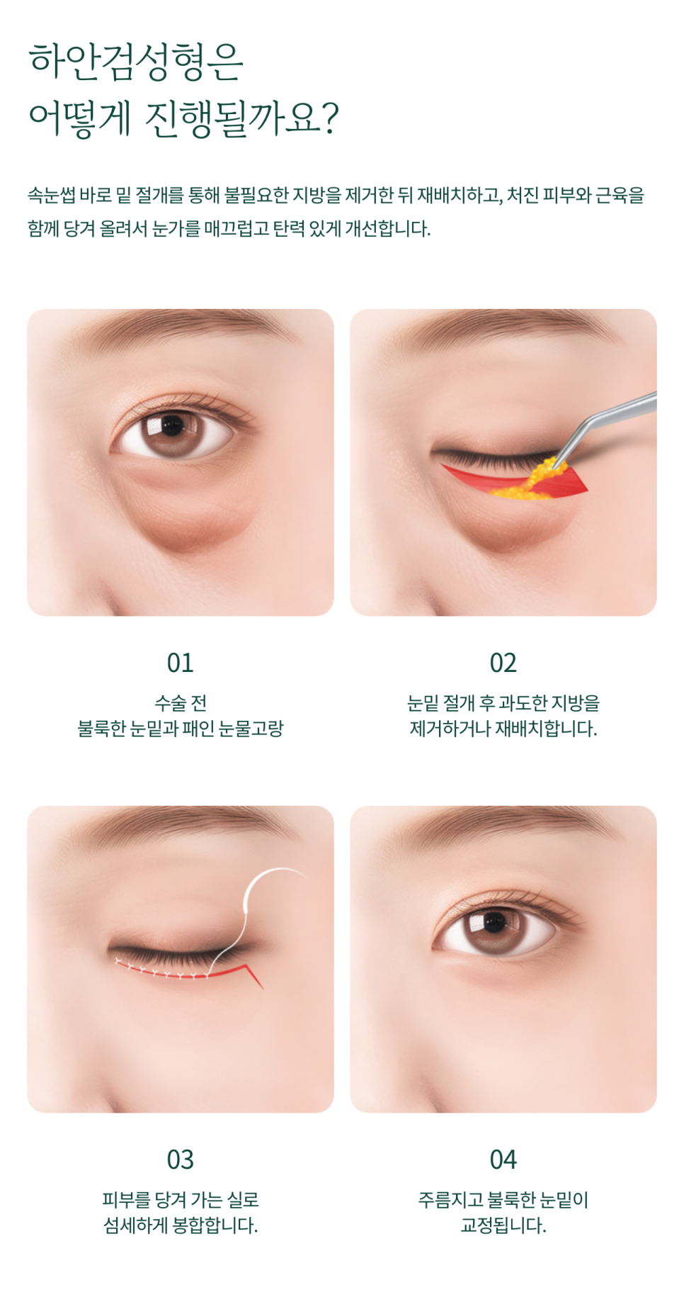 Improving the Under-Eye Area to Make the Eyes Look Younger at Sinyongsan Plastic Surgery image 3