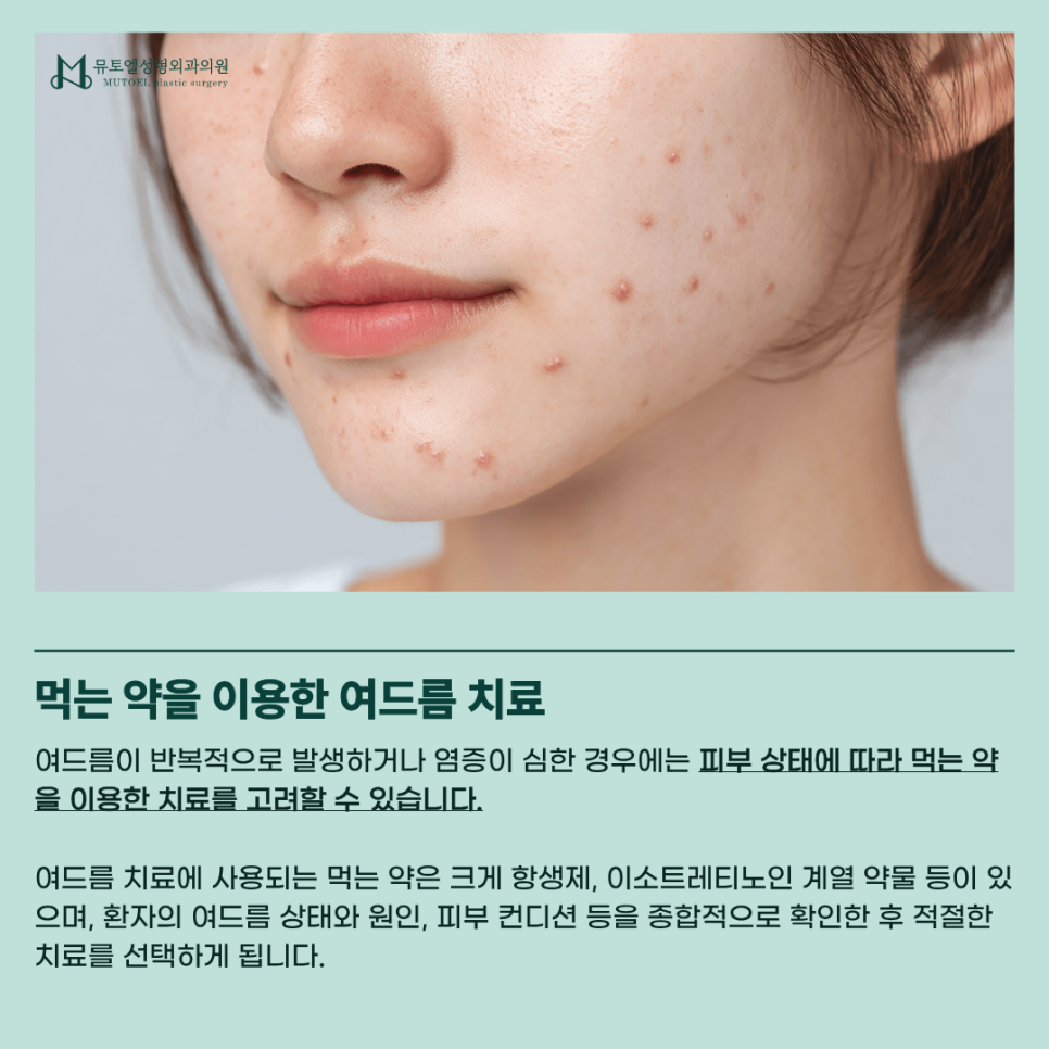 여드름 치료, 먹는 약부터 압출·포텐자·레이저까지 알아보기 관련 이미지 3