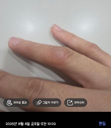 Cryotherapy Review for Finger Warts and a Video of the Actual Treatment Process Included image 13