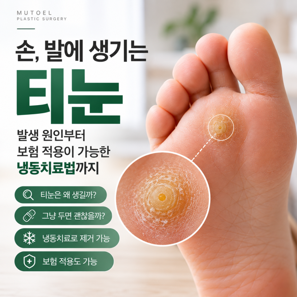 손, 발에 생긴 티눈 냉동치료로 제거할 수 있을까? 보험 적용까지 알아보기 관련 이미지 1