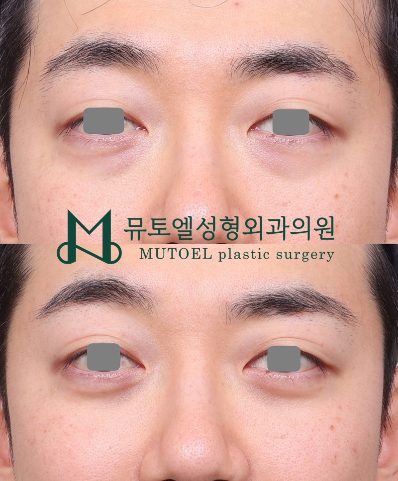 Under-Eye Fat Repositioning and Lower Blepharoplasty: A Choice That Improves Your Impression image 4